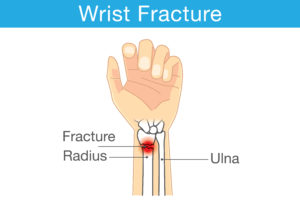Fractures