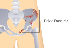Pelvic injuries