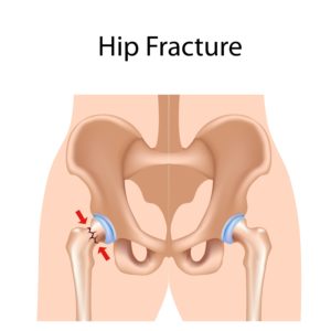 Pelvic injuries